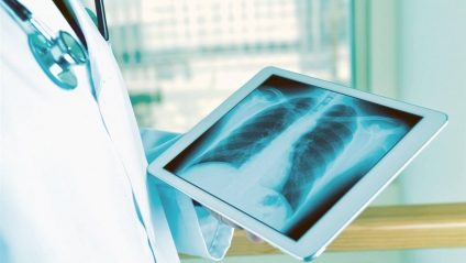 Cáncer de pulmón: piden incorporar la tomografía como estudio de rutina para detección precoz