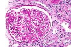 ¿Qué es la Glomerulonefritis Membranosa?